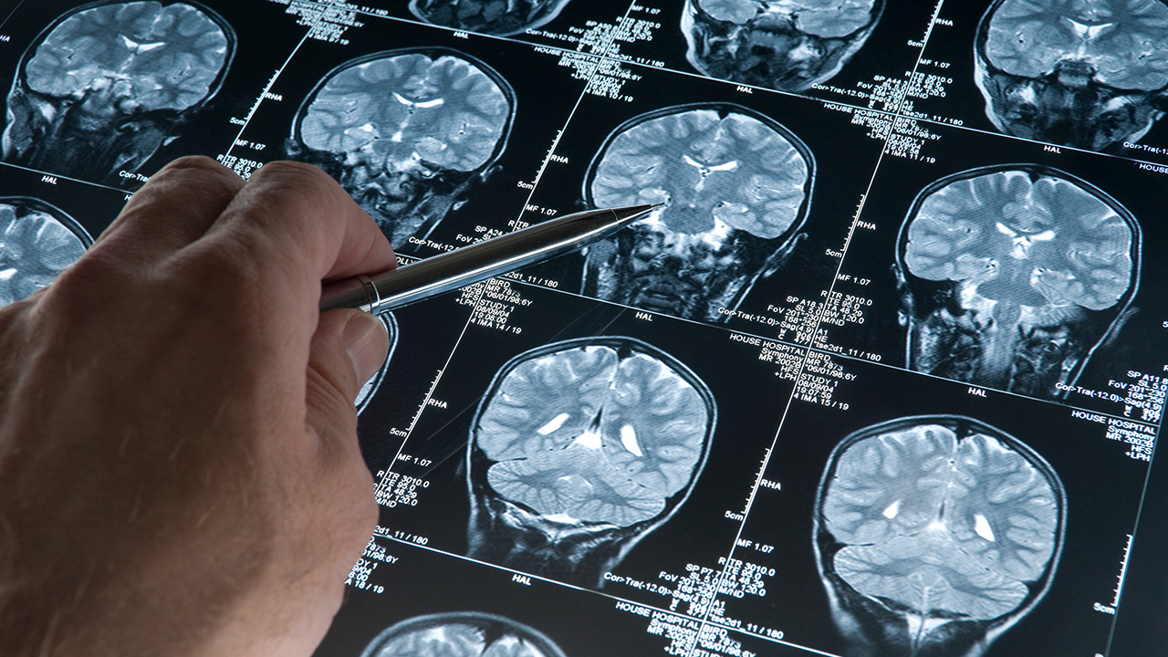 Brain Damage In COVID-19 Patients Revealed In Study - Infomance 