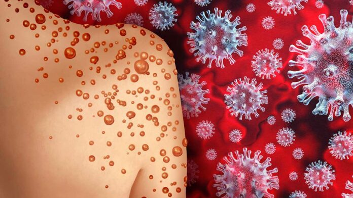 Imported Monkeypox case makes an appearance in Chongqing in China-infomance